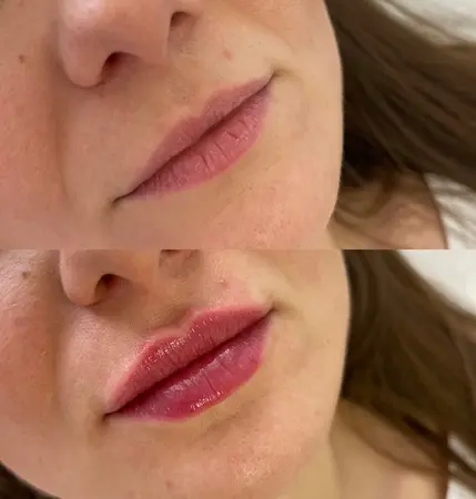 Výplň pier - Prípad 1