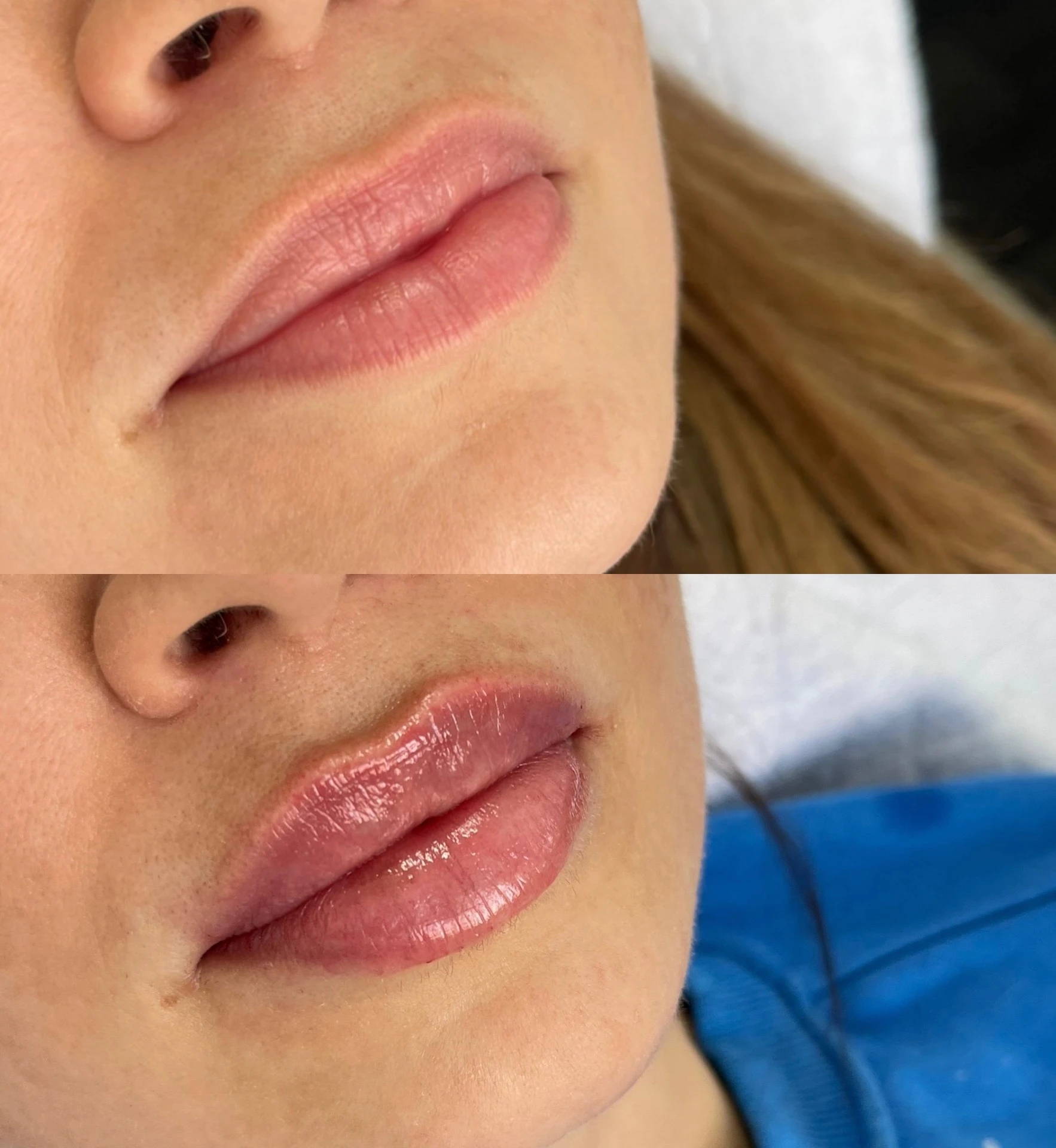 Výplň pier - Prípad 10