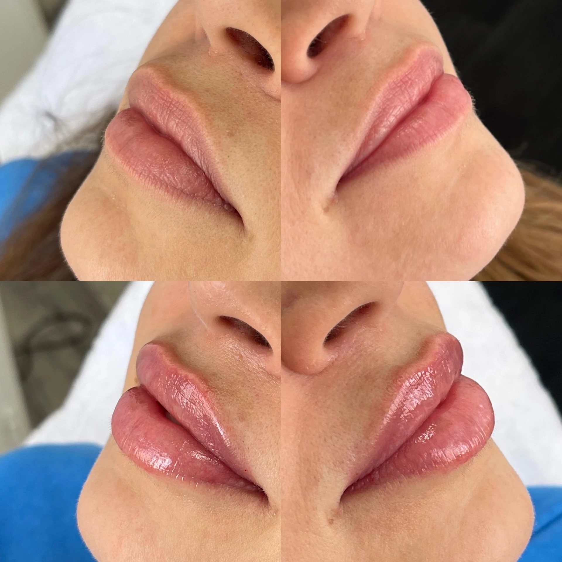 Výplň pier - Prípad 11