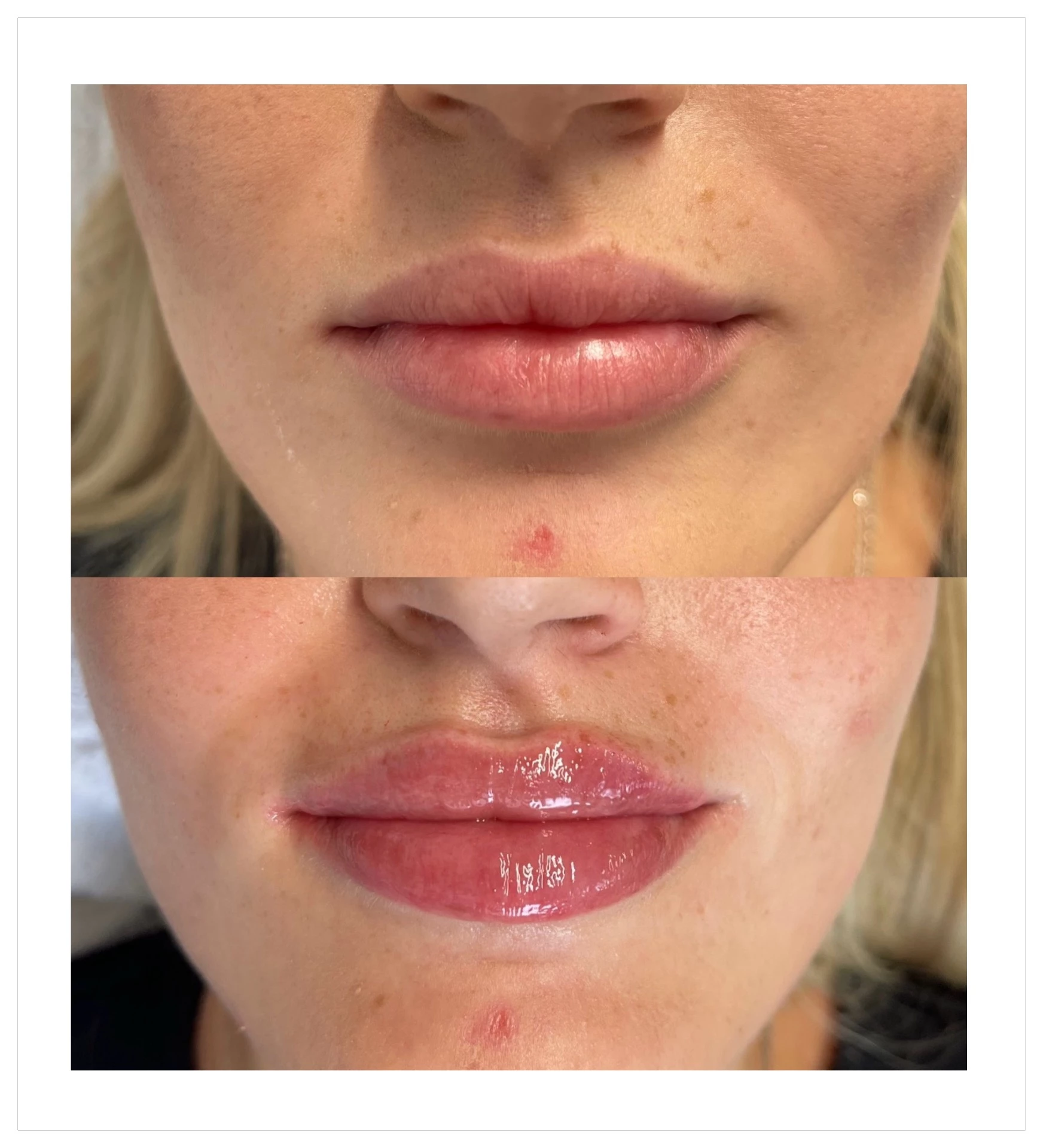 Výplň pier - Prípad 12