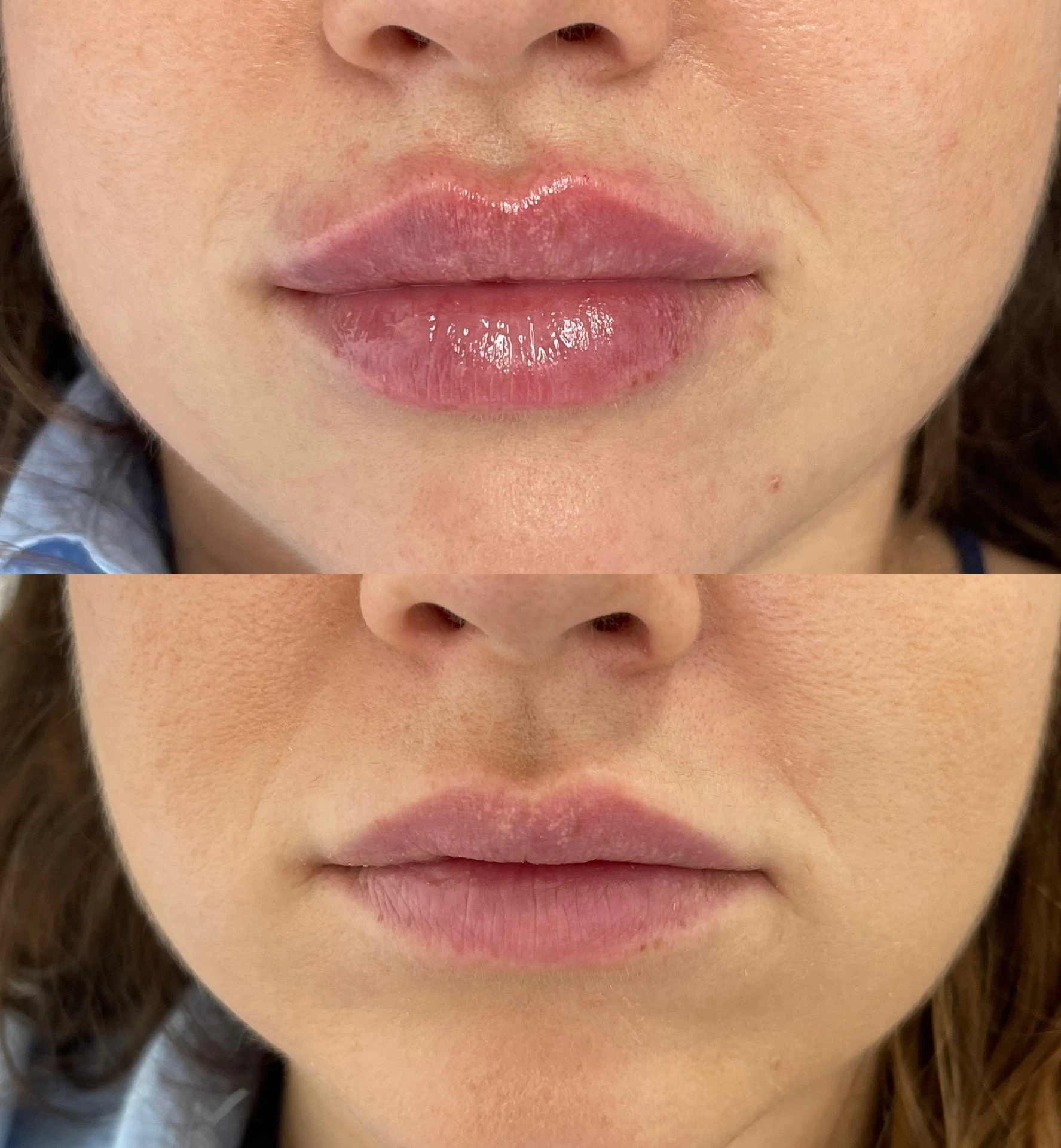 Výplň pier - Prípad 13