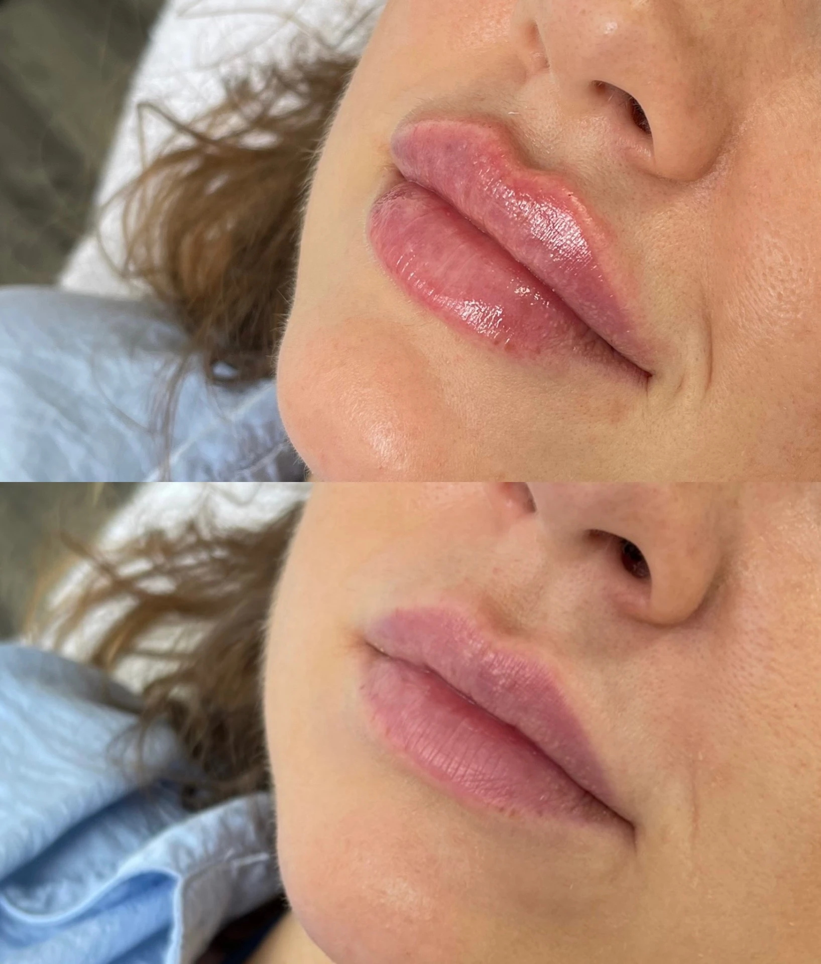 Výplň pier - Prípad 14