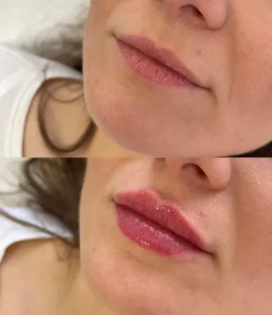 Výplň pier - Prípad 2