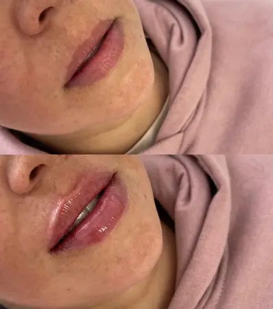 Výplň pier - Prípad 3