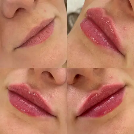 Výplň pier - Prípad 4