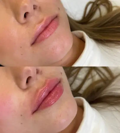 Výplň pier - Prípad 5