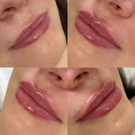 Výplň pier - Prípad 7