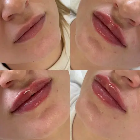 Výplň pier - Prípad 8