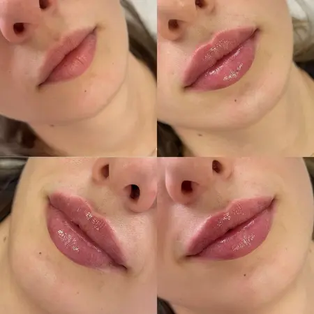 Výplň pier - Prípad 9